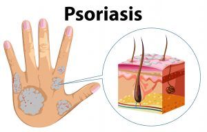 Psoriasis diagram