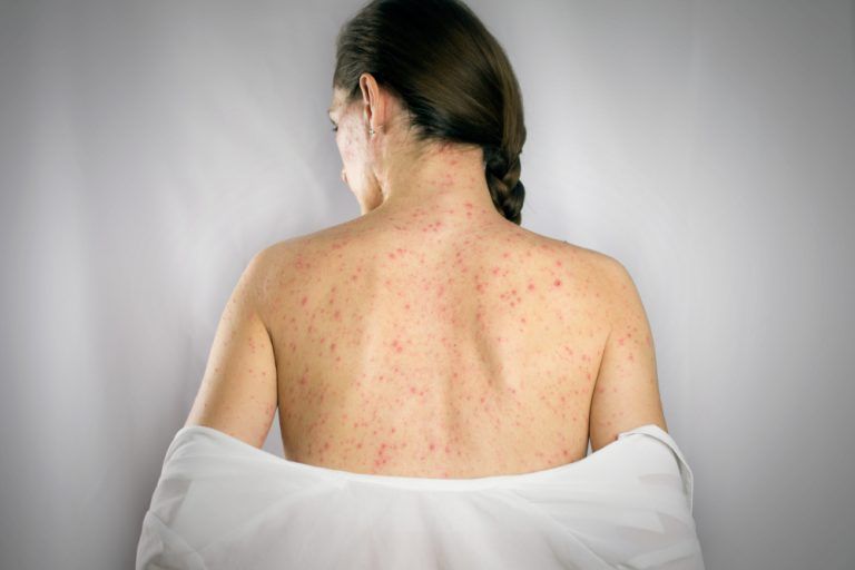 Whats The Most Effective Way To Treat Shingles Can It Be Done Naturally Savehealth