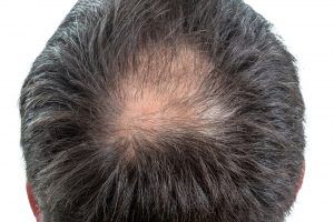 bald patch forming