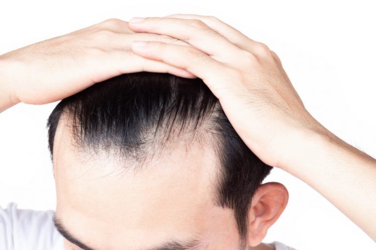 dutasteride for hair loss