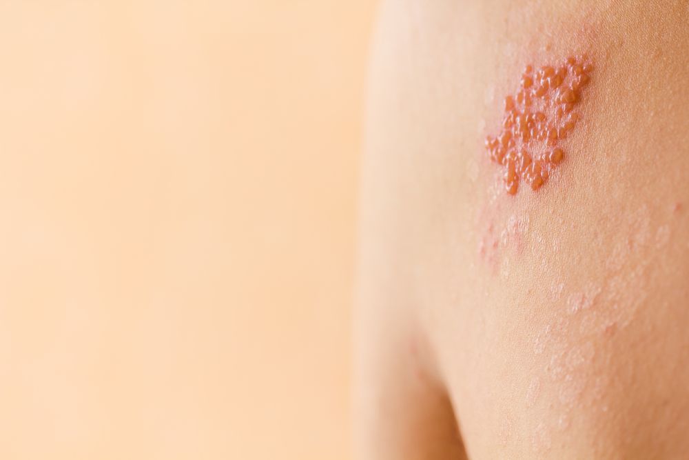 What Are the Symptoms of Herpes? Save.Health