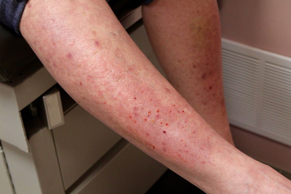 Dermatitis Herpetiformis Treatment Options Celiac Rash Save Health