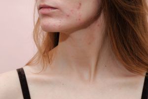 woman with acne