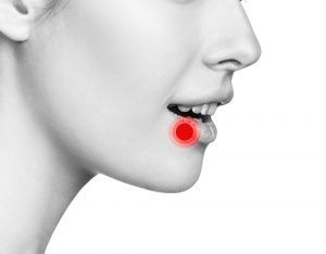 either canker sore or cold sore