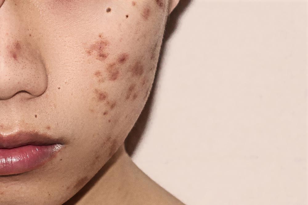 The Best Medications to Get Rid of Acne in 2019