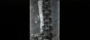 x ray of vena cava filter